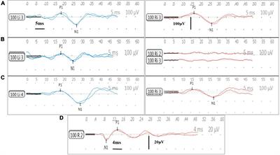 Minimally invasive surgical techniques in vestibular function preservation in patients with cochlear implants
